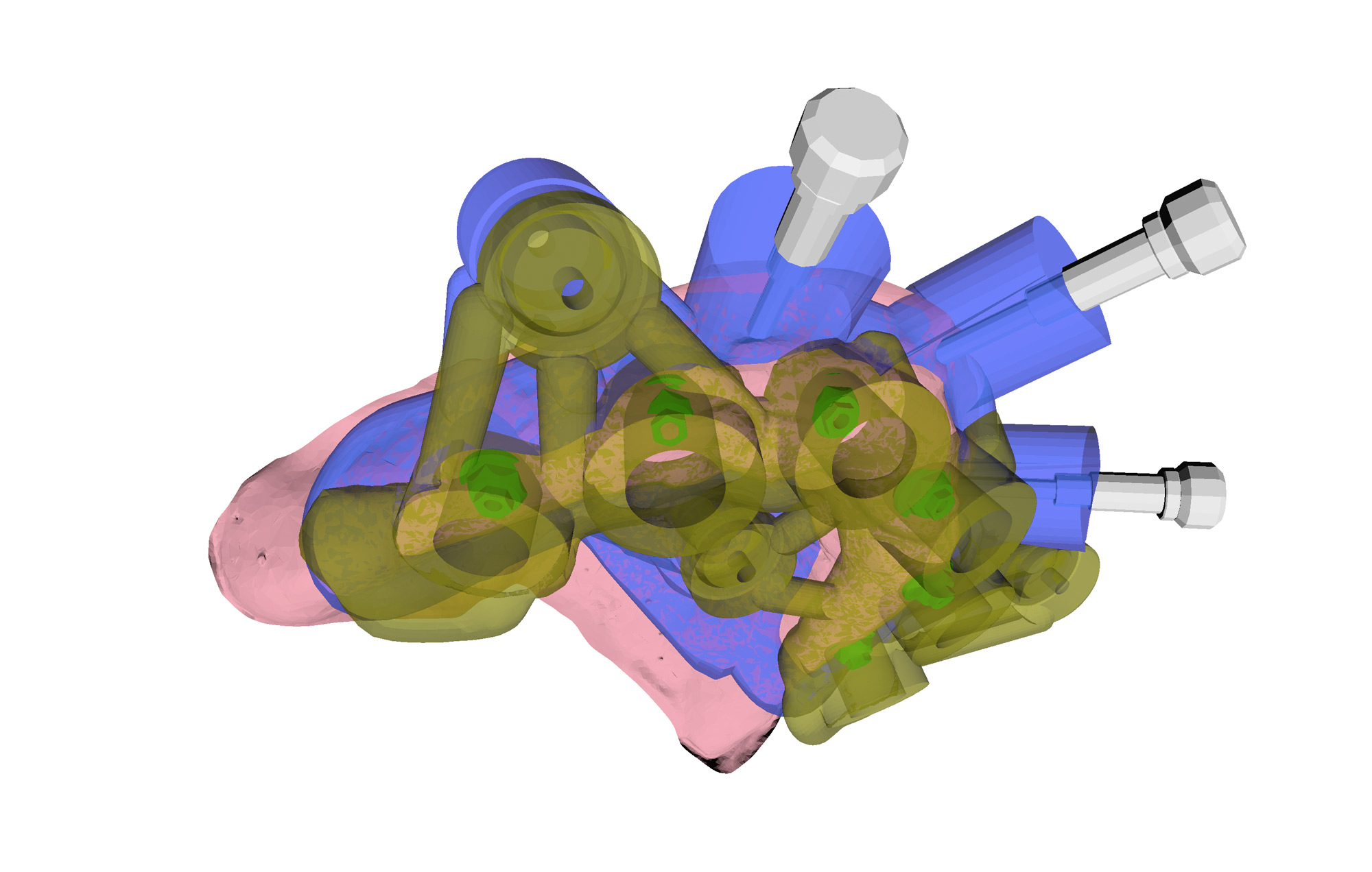 Cirugía implantológica más precisa gracias a Nium Guide, powered by Biteright